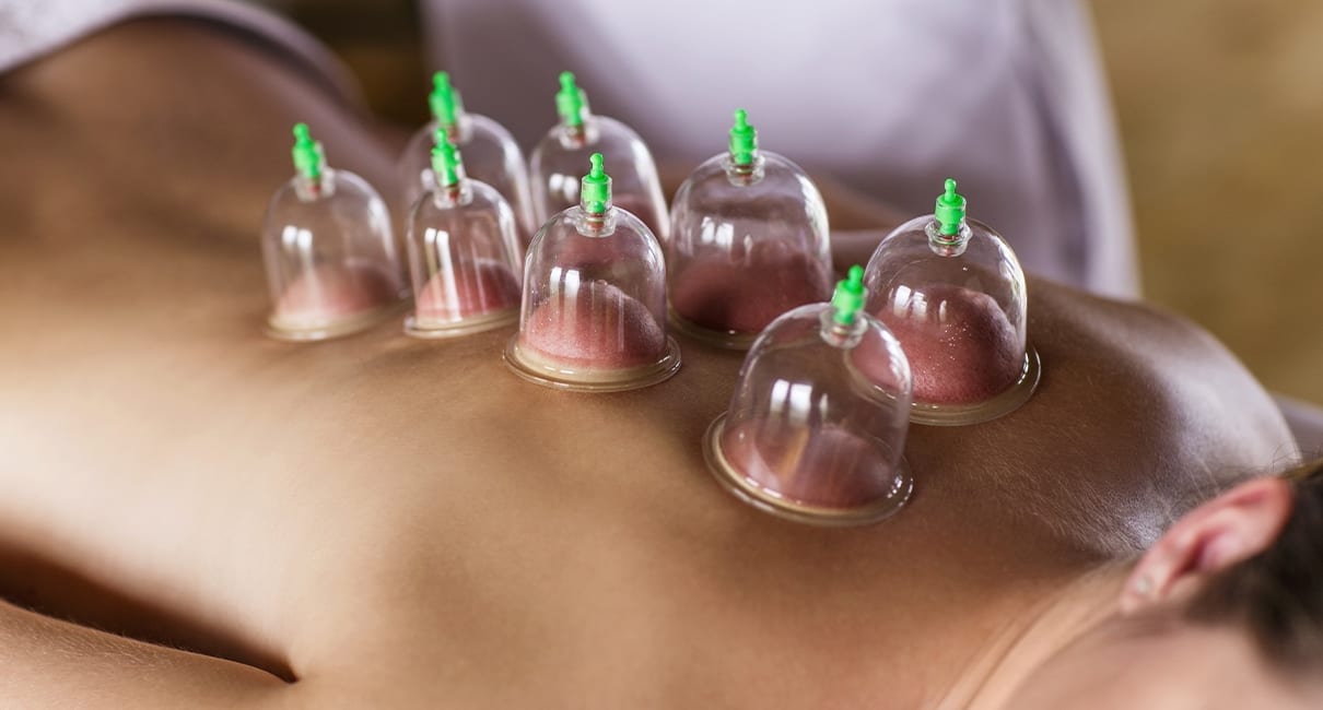 Myofascial Cupping | On-Campus Short Course
