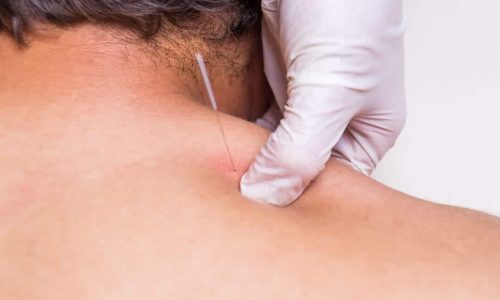 DryNeedlingBanner DryNeedlingBanner